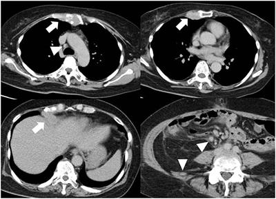 Endovascular Therapy for Concurrent Cardio-Cerebral Infarction in a Patient With <mark class="highlighted">Trousseau</mark> Syndrome